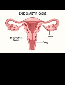 Understanding Endometriosis